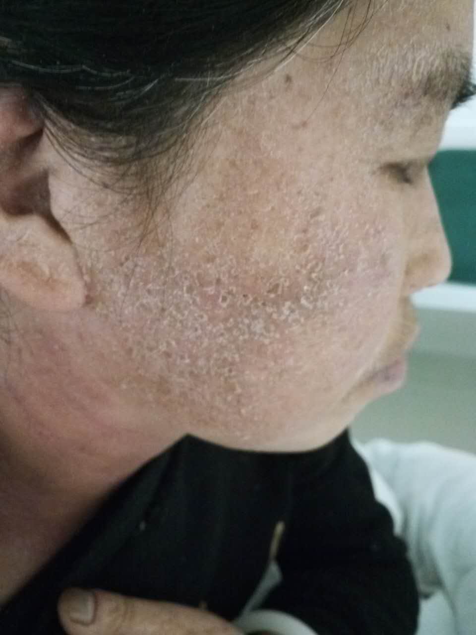 照片里的可怜人，由于头发焗油而导致全身过敏性皮炎，在诊所看了一个月没有好转，用可丽金健肤喷雾+可愈16 ...