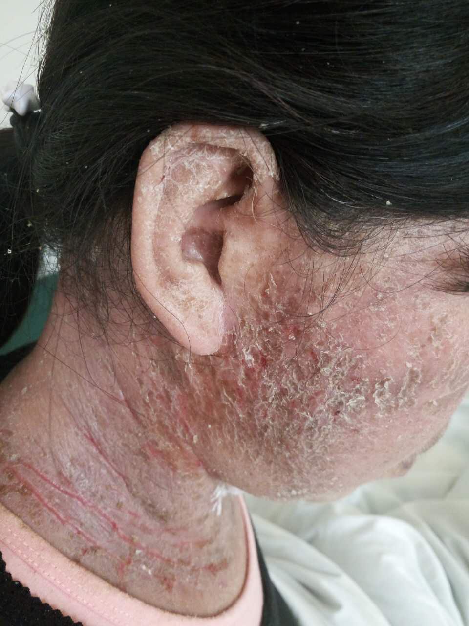 照片里的可怜人，由于头发焗油而导致全身过敏性皮炎，在诊所看了一个月没有好转，用可丽金健肤喷雾+可愈16 ...
